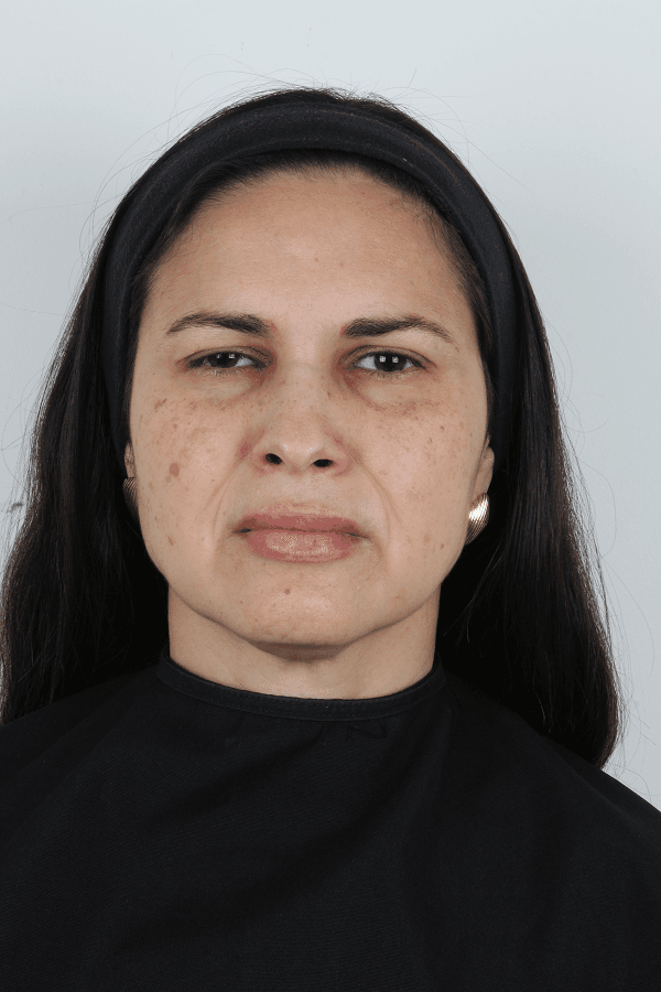 Toxina Botulínica - Depois