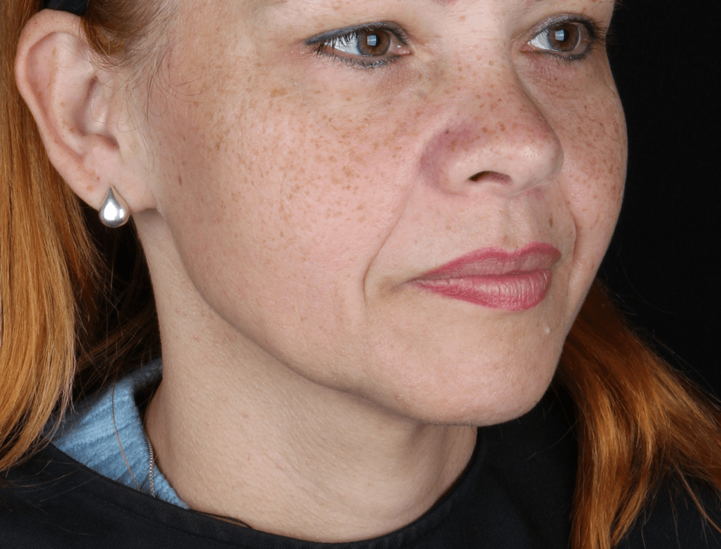 Preenchimento Labial - Antes