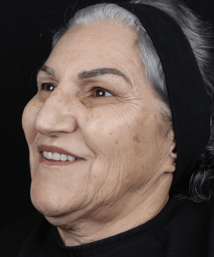 Preenchimento Facial - Depois